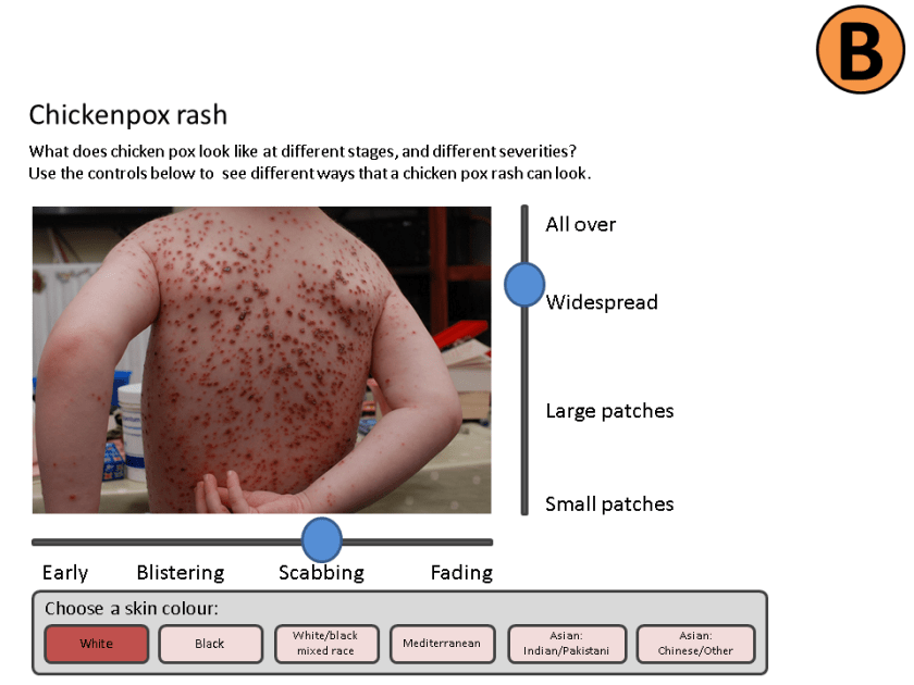 Chickenpox prototype 2